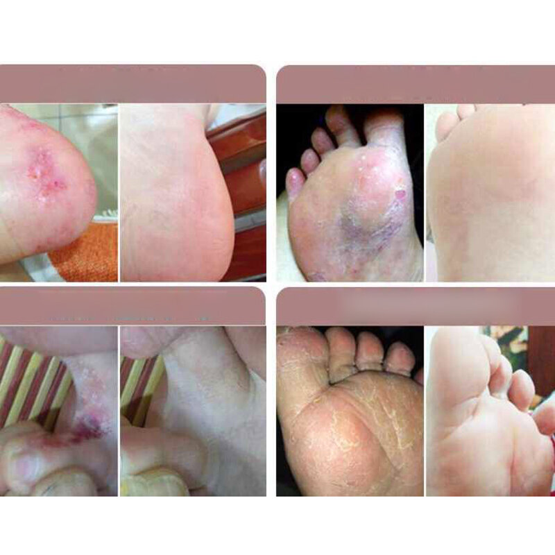 Herba โรคเหน็บชา Anti-Itch สเปรย์เชื้อราเท้านักกีฬาคันครีม Toe Lnfections Peeling Treatment ระงับกลิ่นกายฟุต2PCS