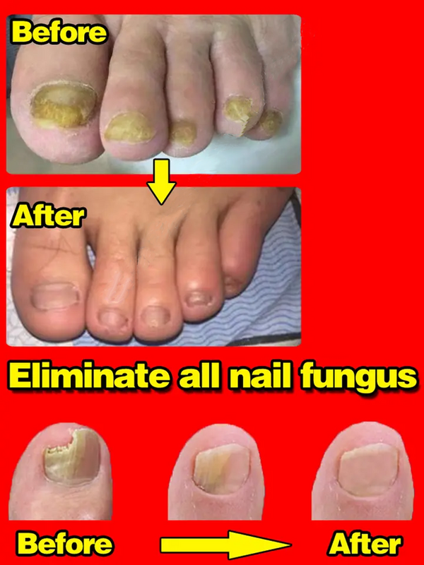 Siero per il trattamento dei funghi delle unghie onicomicosi paronichia Anti infezione Toe fungo rimozione del piede della mano riparazione cura del Gel bellezza salute