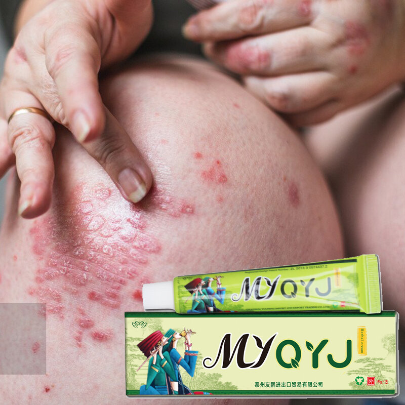 20 peça yiganerjing miao yao dermatite eczema psoríase pomada china cremes pomada atacado 10/20 pçs 15g