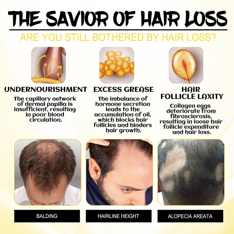 Potente suero para el crecimiento del cabello, tratamiento Anti pérdida de cabello, crecimiento rápido del cabello, Alopecia seborreica, línea de cabello, folículo capilar, cuidado saludable