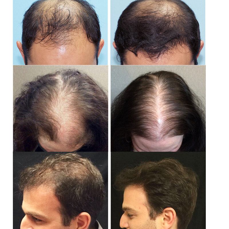 Gengibre crescimento do cabelo soro anti perda de cabelo óleo essencial rápido crescer cabelo líquido cuidados de saúde reparação beleza danificado couro cabeludo seco frizzy