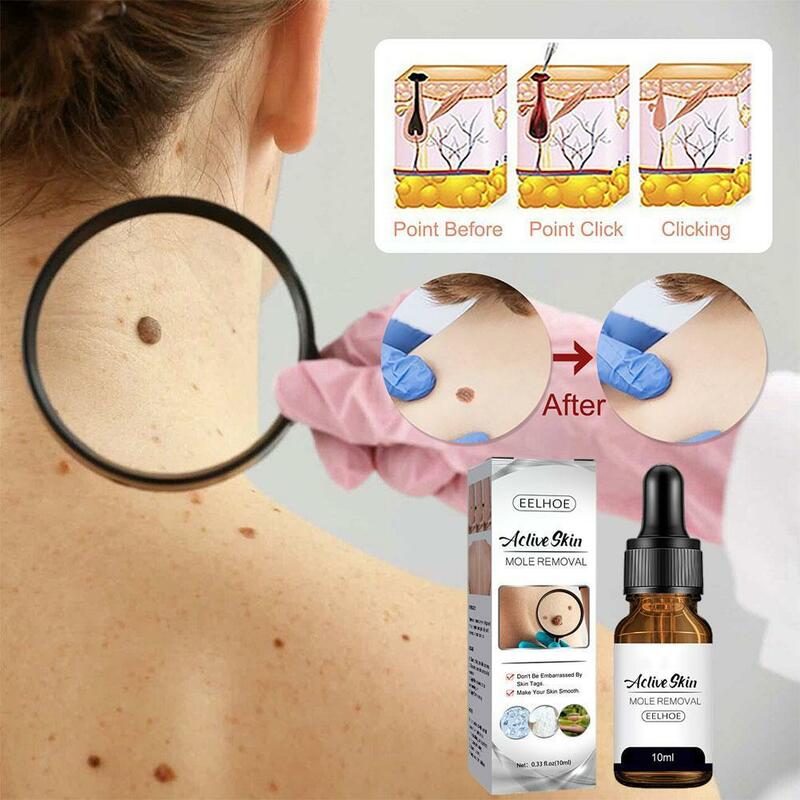 Solución para el cuidado corporal, esencia de lunares y verrugas, eliminación de cara y piel, limpieza de axilas, cuidado de carne, reparación de la piel del cuello