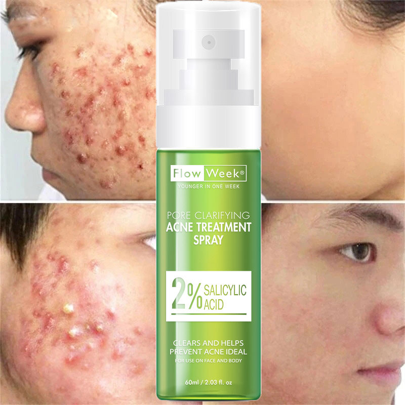 Flow Week Akne entfernen Spray zurück & Körper Akne Spray zurück Akne-Behandlung Bio für Körper Akne-Behandlung Hautpflege