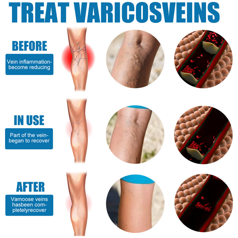 30ml Varicose Vein Massage Active Lotion Spray Vascular Bulge Leg Massage Spray Varicosity Angiitis Pain Relief Body Care Cream