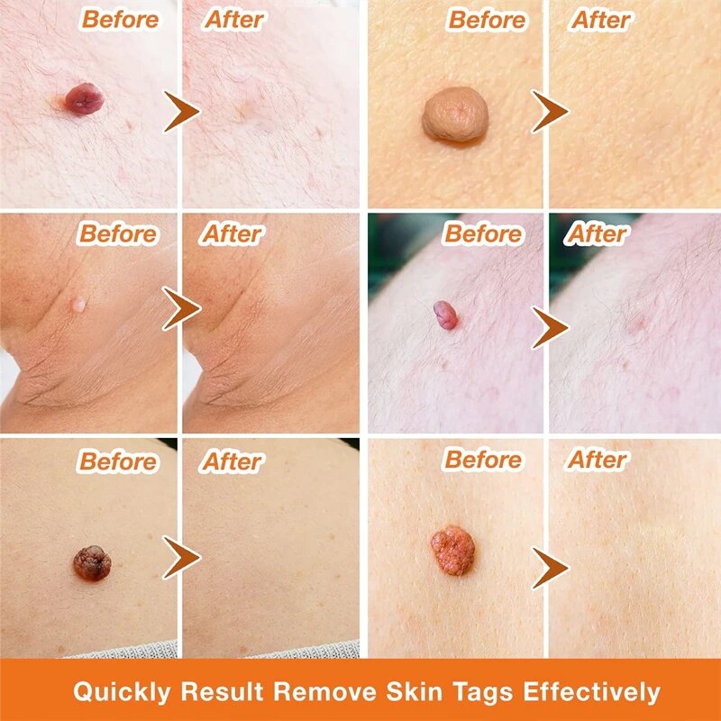 Skin Tag Remover Essential Oil Painless Mole Skin Dark Spot Warts Remover Serum Freckle Face Wart Tag Treatment Removal Cream