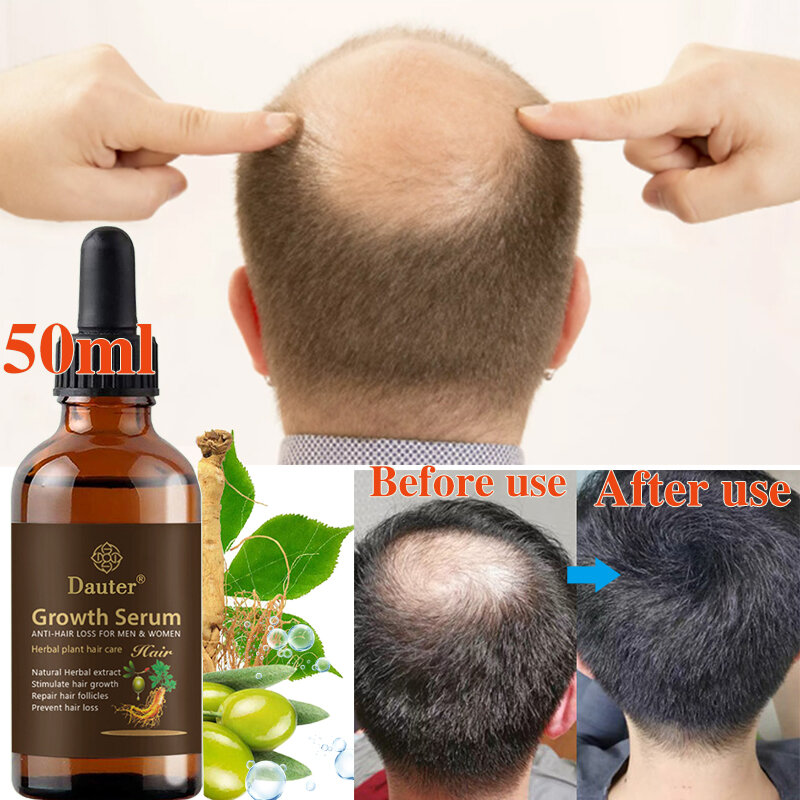 Sérum de croissance capillaire au gingembre, spray anti-perte de cheveux, produits efficaces, à croissance rapide, soins pour le cuir chevelu, contre les dommages et la sécheresse