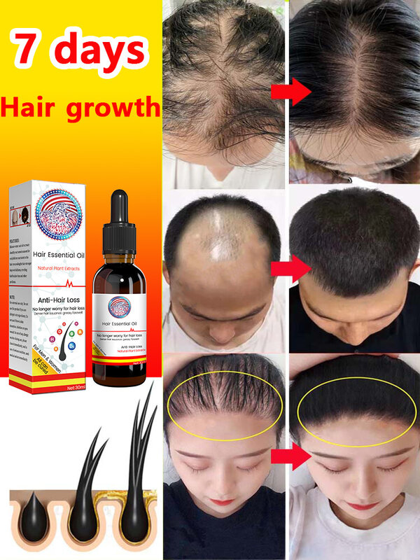 Aceite para el crecimiento rápido del cabello, reparación eficaz de la calvicie, pérdida de cabello postparto, pérdida de cabello seborreica