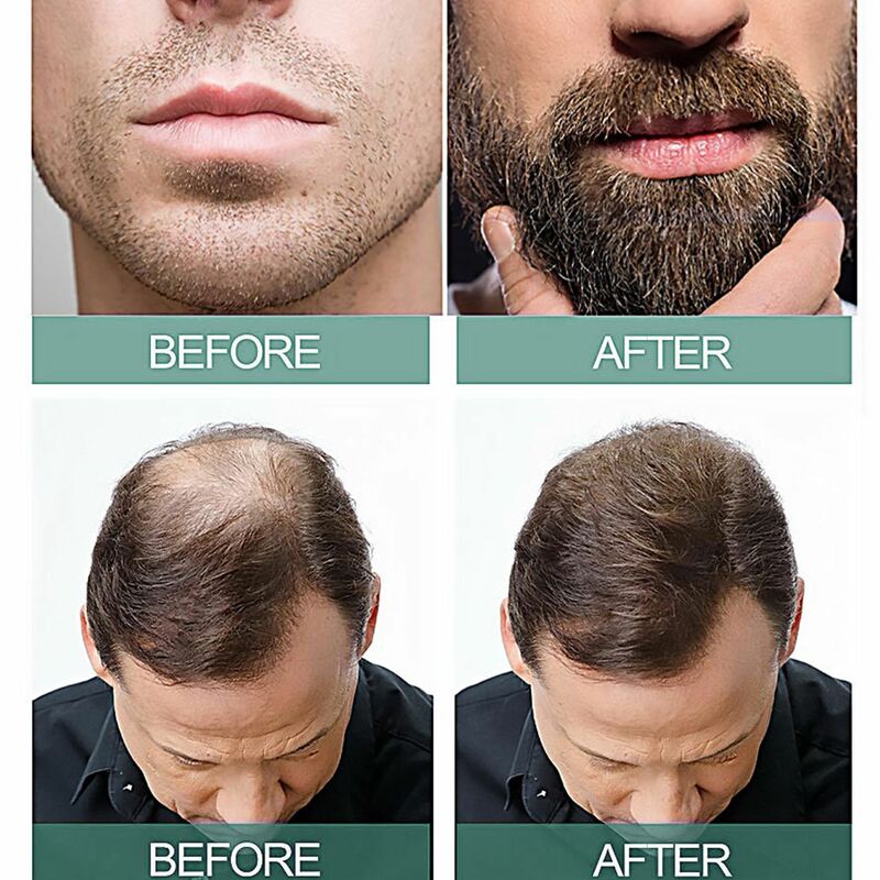 Suero de jengibre para el crecimiento del cabello, reparación efectiva, pérdida de cabello posparto, Alopecia seborreica, crecimiento rápido, 7 días