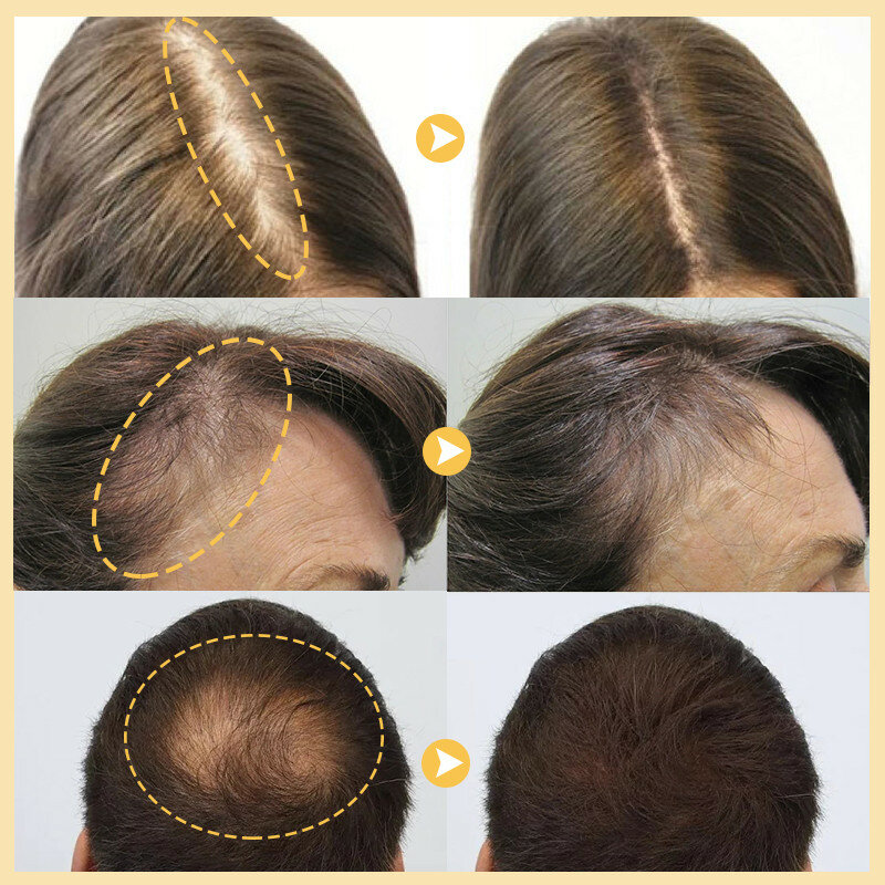 African Crazy Hair Growth Serum Spray Alopecia Treatment Anti Hair Loss Oil Thinning Hair Becomes Thicker Oil Control