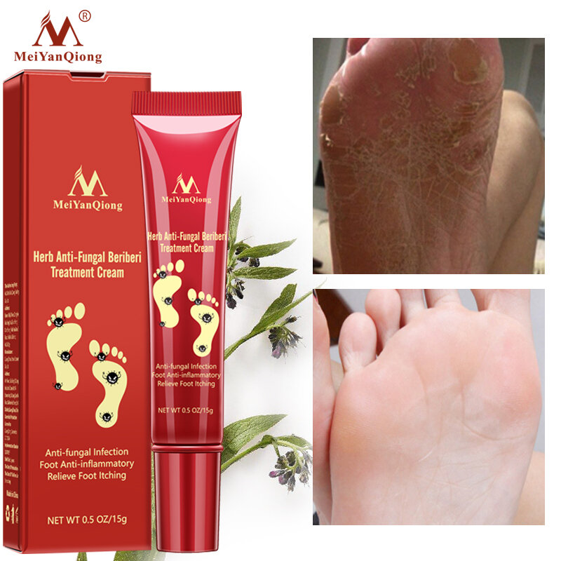 Tratamiento Herbal para pies, antiinfección por hongos, onicomicosis, paroniquia, eliminación de hongos en el dedo del pie, cuidado de la piel muerta de los pies, 3 uds.