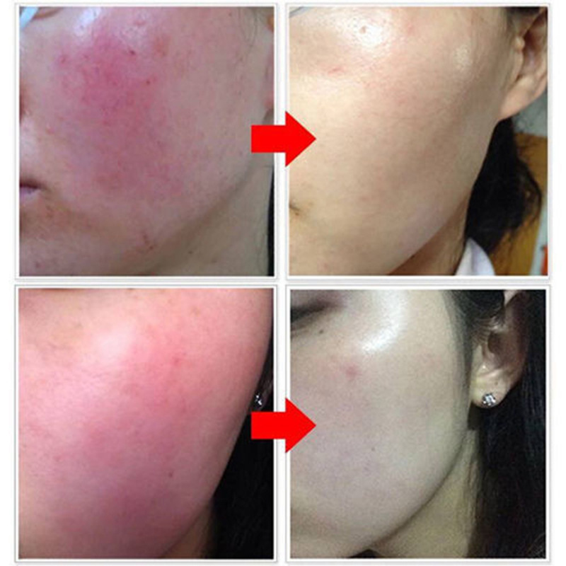 Efficie anti vermelhidão solution rosto soro reparação aranha veia essência líquido face lift empresa clareamento iluminar cuidados com a pele coreana
