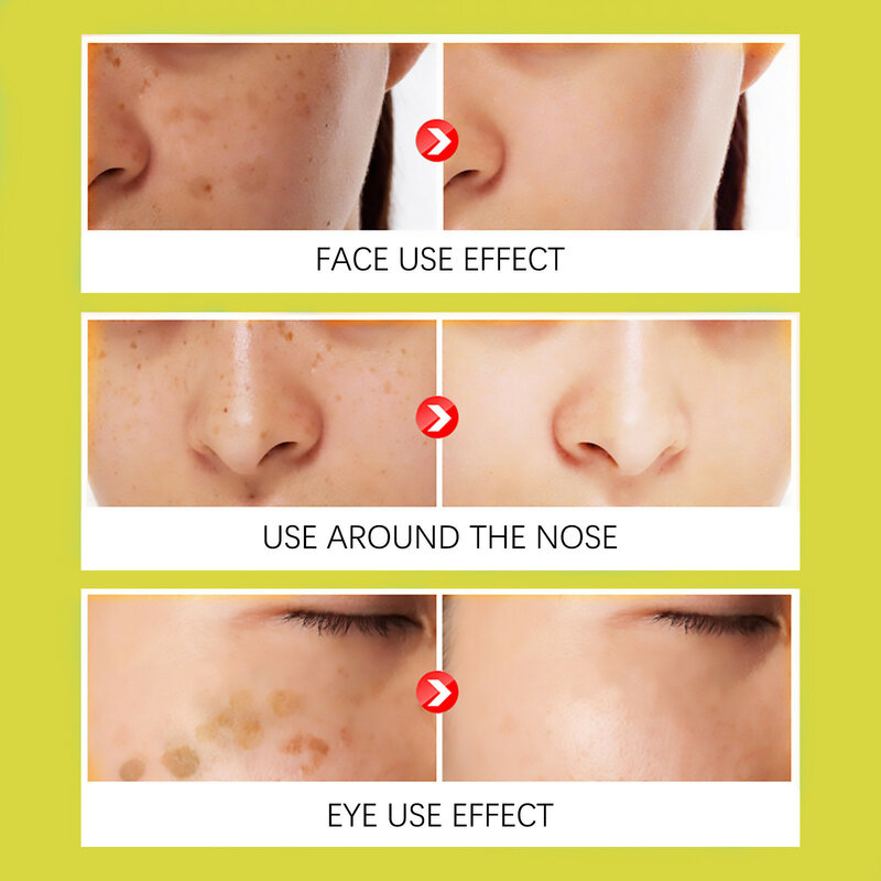 ขมิ้น Whitening Freckle Remove Skin Care ชุดสีดำสิวแผลเป็นจางหายเมลานิน Moisturizing Repair Brighten Beauty Korea Produc