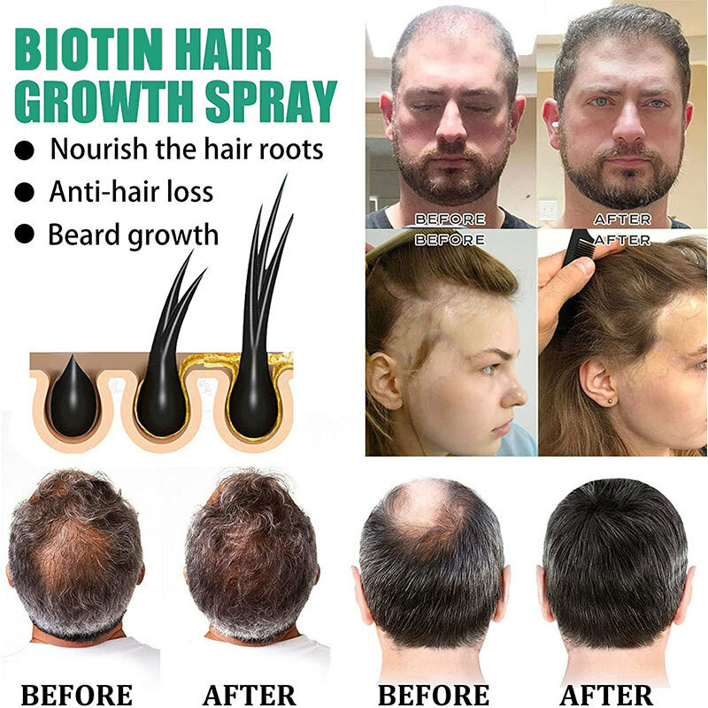 Schnelles Haar wachstum Serum Spray natürliche Anti-Haarausfall-Reparatur beschädigte Haarwurzeln starke Regeneration Kopfhaut pflege Schönheit Gesundheit