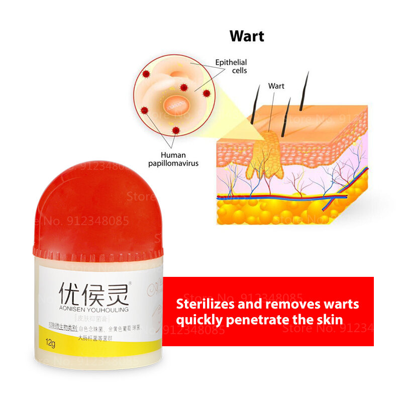 Body Warts Treatment Cream Skin Care Tag Remover Ointment 100% Herbal Medicine Warts Ointment Foot Corn Removal Plantar