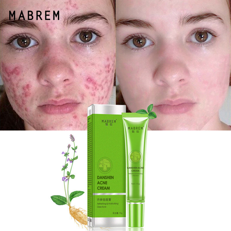 Danshen Acne Removal Cream Anti Acne Treatment Fade Dark Spots Pimples Oil Control Clean Pores Moisturizing Whitening Skin Care