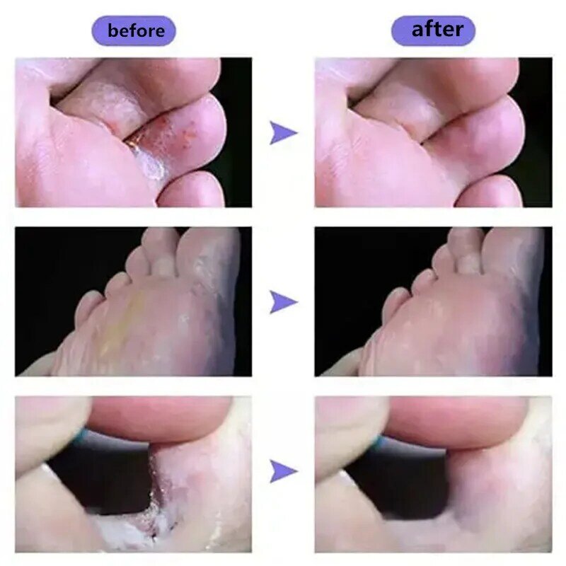 Foot Careครีมเท้าสมุนไพรDetox Anti Fungal Onychomycosisเชื้อราครีม