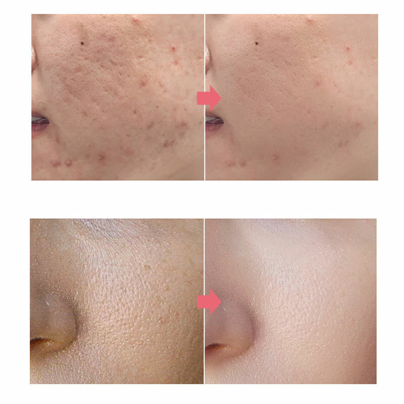 Tè verde controllo dell'olio pori Shrink Face Serum Whitening rimuovi macchie scure migliora l'acne punti neri cura della pelle secca cosmetici coreani