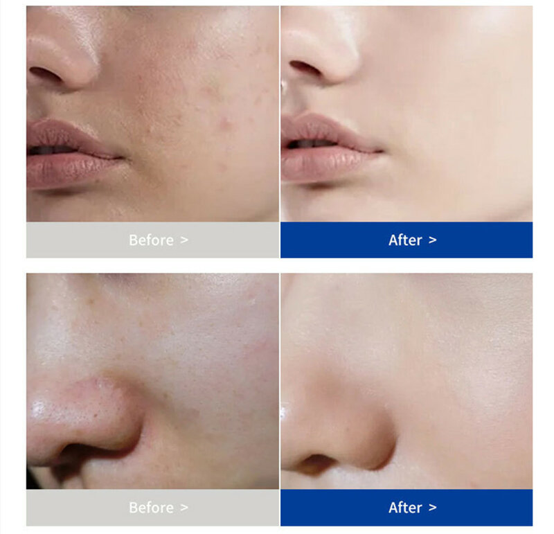 Controllo dell'olio Acne idratante riduzione dei pori riparazione siero sbiancante antirughe crema schiarente per il viso Set per la cura della pelle degli uomini
