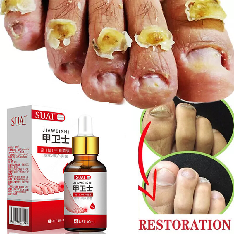 Tratamento fúngico do prego soro onychomycosis paronychia anti infecção dedo do pé fungo mão pé reparação gel cuidados beleza saúde