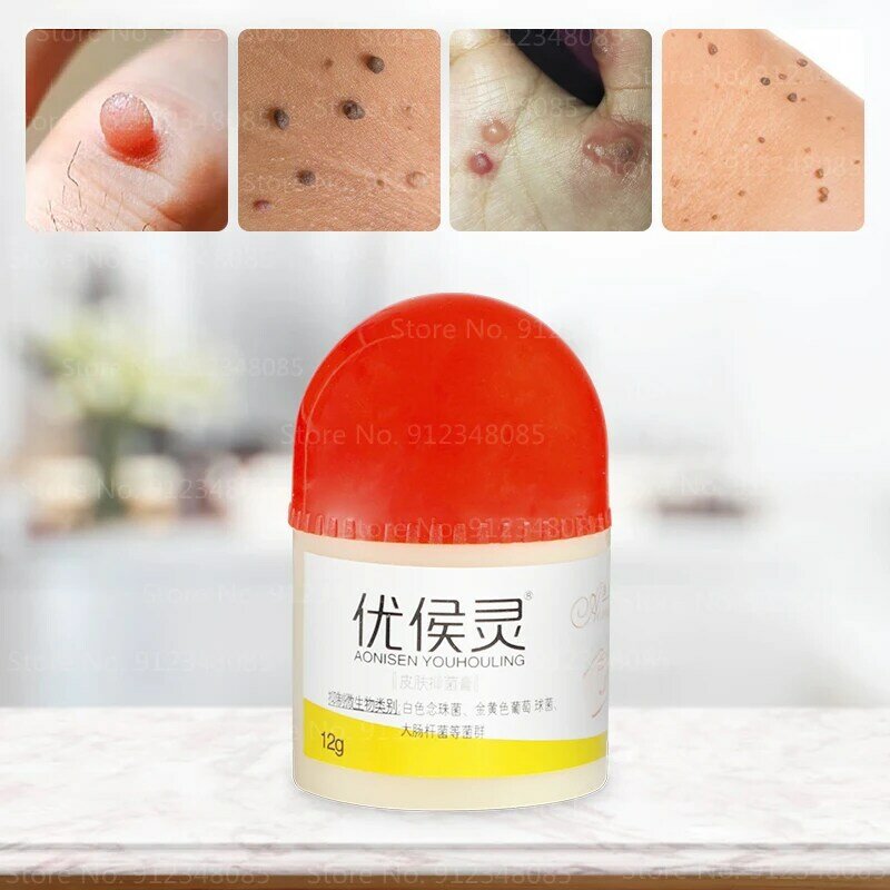 Körper Warzen Behandlung Creme Hautpflege Tag Entferner Salbe 100% Kräuter Medizin Warzen Salbe Fuß Mais Entfernung Plantar