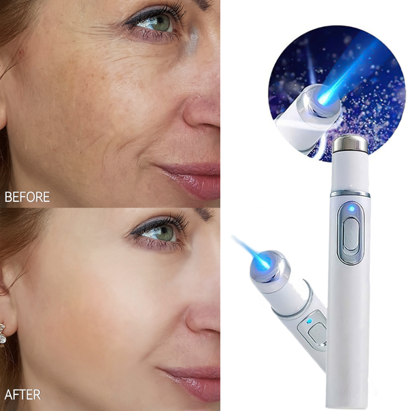 Acne Wrinkle Removal Laser Pen Skin Spots Removal Anti Varicose Spider Vein Eraser Treatment Portable Medical Blue Light Therapy