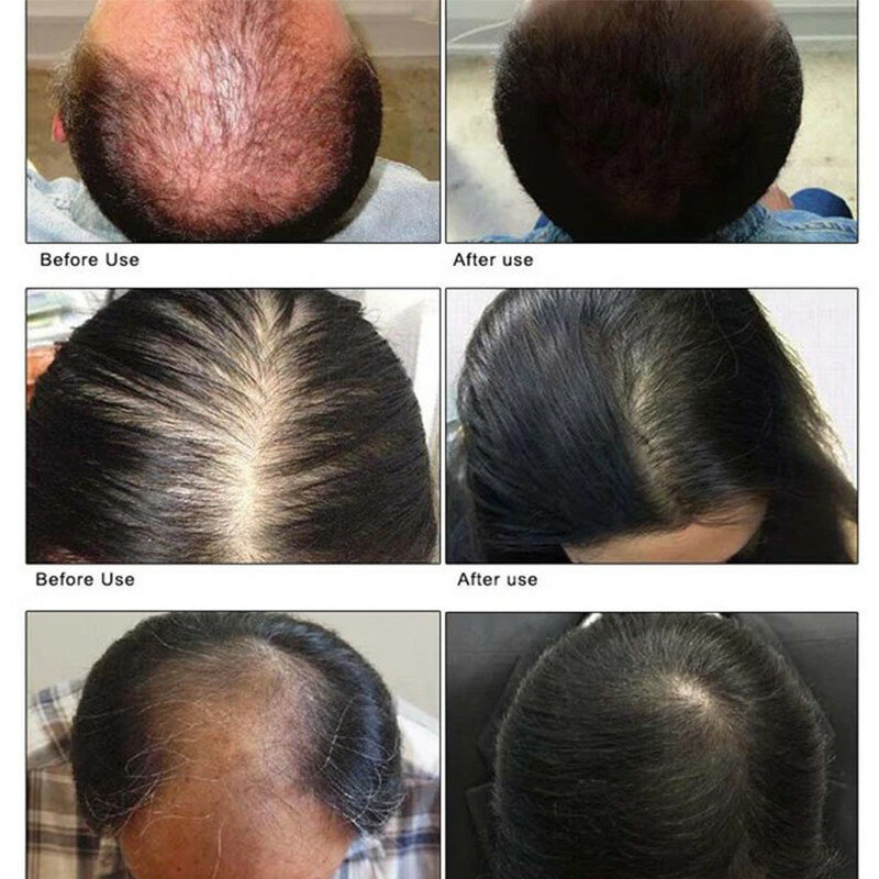 Rosmarin Haar Wachstum Ätherisches Öl Anti Haarausfall Schnell Wachsenden Keim Serum Reparatur Schaden Öl Haarausfall Kopfhaut Behandlung Produkt