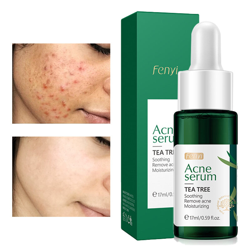 Siero per l'acne riparazione nutriente trattamento idratante per l'acne riduzione dei segni dell'acne pori restringenti lenitivi controllo dell'olio cura della pelle