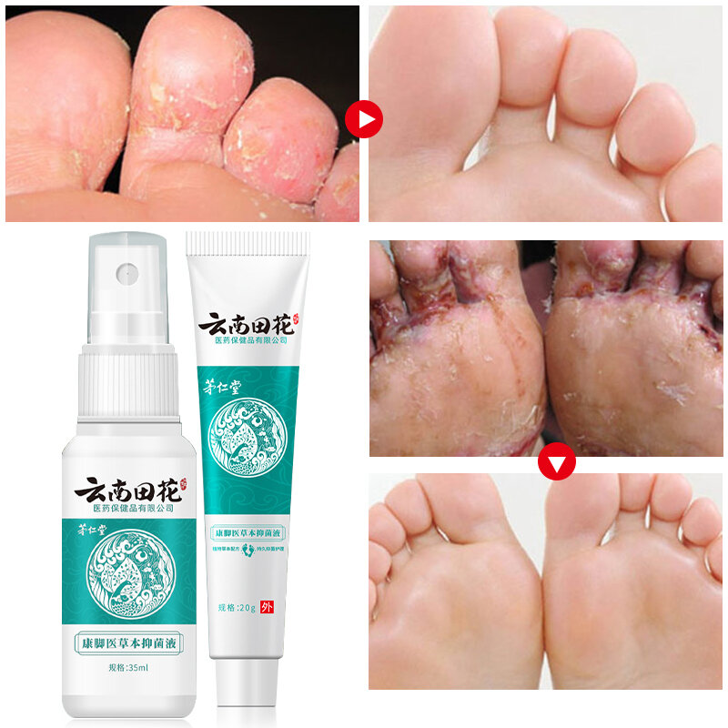 Herba Beriberi Anti-Itch Spray Antifungal Athlete's Foot Itching Cream Toe Lnfections Peeling Treatment Deodorant Feet Care 2PCS