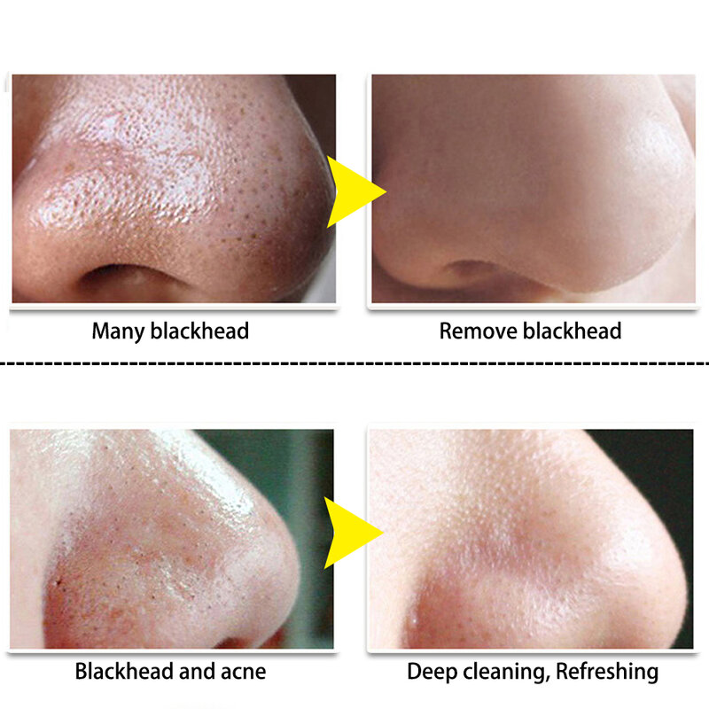 Lanbena removedor de cravo máscara de nariz poros tira máscara preta peeling acne tratamento preto limpeza profunda shrinking poros cuidados com a cara