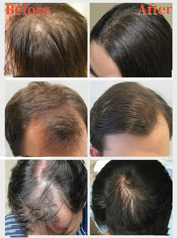 Hair Growth Condition Serum 3-in-1 Roller Ball Massager Nourish Dense Long Hair Organic Essential Oil Ginger Anti-Hair Loss