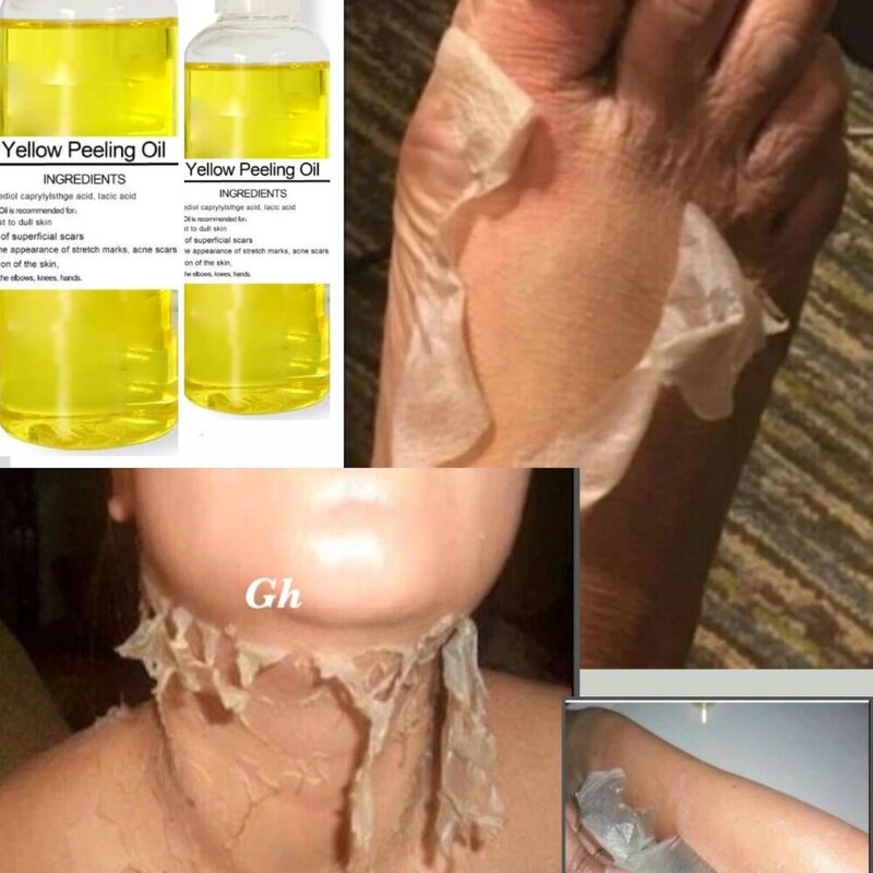 Óleo de peeling amarelo forte óleo de casca amarelo clarear cotovelos joelhos mãos melanina mesmo tom de pele e clarear a pele