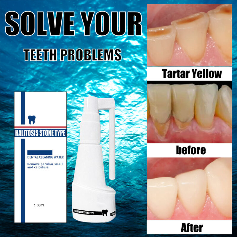 Cálculo dental dissolução spray bactérias desodorização dental cálculo duradouro e refrescante clareamento ferramenta de cuidados 30g