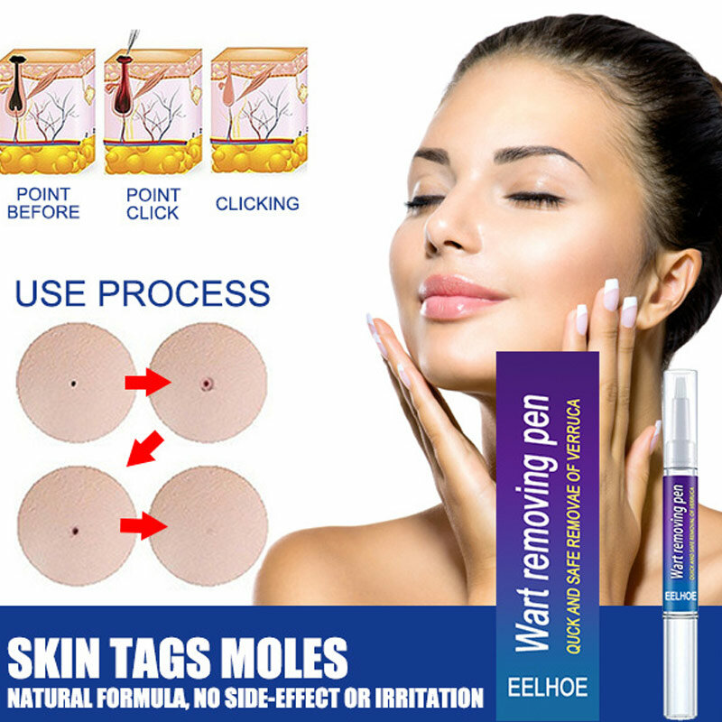 Wart Remover Mole Remedy Liquid Pen Treatment Papillomas Flat Removing Skin Labels Wart Genitals Painless Beauty Health 2022 New