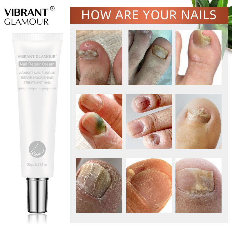 VIBRANT GLAMOUR-Crema para el cuidado de las uñas de los dedos, tratamiento antibacterial para la reparación de los hongos, onicomicosis, paroniquia, 20g