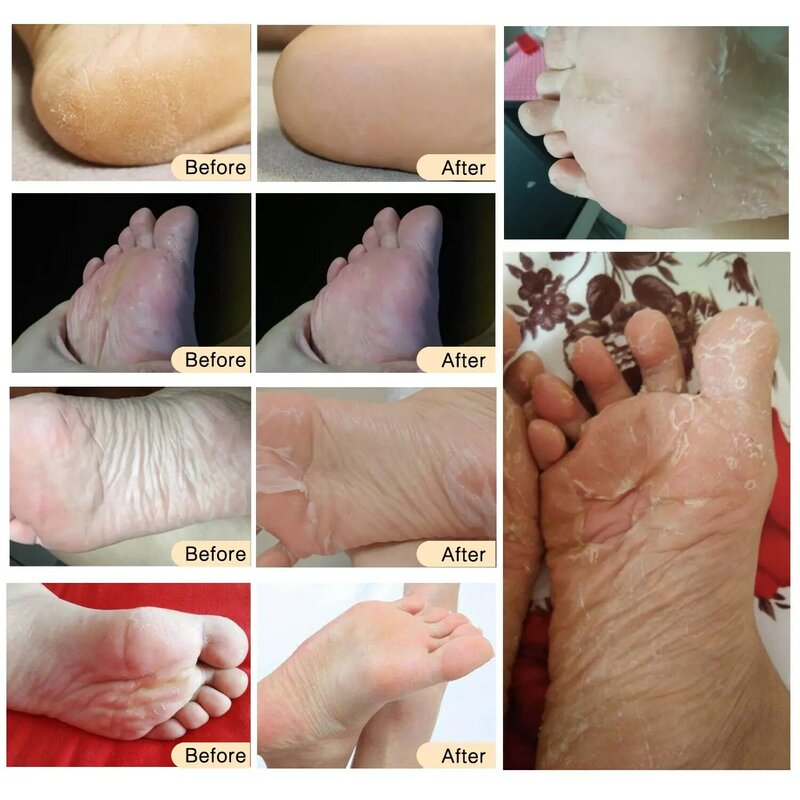 Maseczka złuszczający skórę ze stóp na stopy Peeling martwa skóra maseczka na nogi Sosu skarpetki do Pedicure maska złuszczający skórę ze stóp