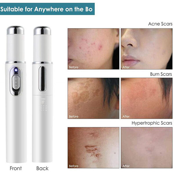 Caneta de laser portátil para remoção de acne, máquina de massagem durável, macia, dispositivo de remoção de cicatriz, terapia de luz azul, drop