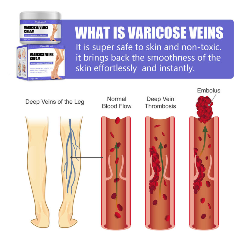 Varicose Veins Care Cream Relief Varicose Vein Soothing Leg  Vasculitis Phlebitis Treatment Earthworm Blood Vessel Swelling 30g