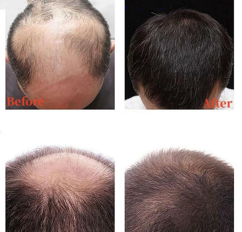 Siero per la crescita dei capelli 3-in-1 Roller Ball Massager nutre i capelli lunghi densi olio essenziale biologico zenzero Anti-caduta dei capelli