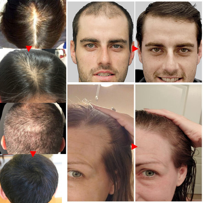 سيروم سماكة الشعر ، يحتوي على مكونات قوية لمنع تساقط الشعر ، علاج إعادة نمو الشعر للرجال والنساء