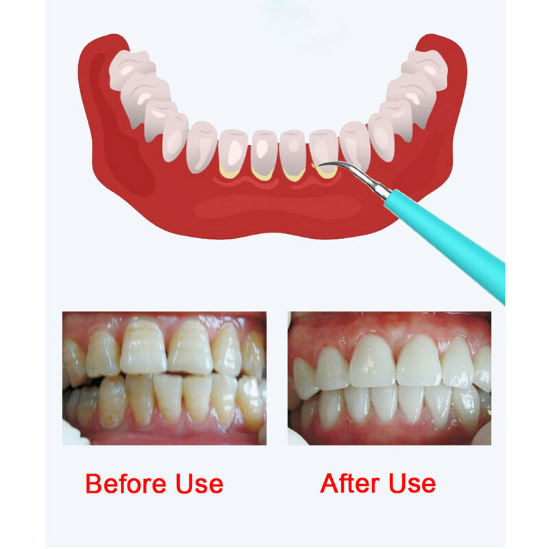Segunda geração elétrica ultra sônico scaler dental dente removedor de cálculo mais limpo manchas de dentes tártaro clarear os dentes remover