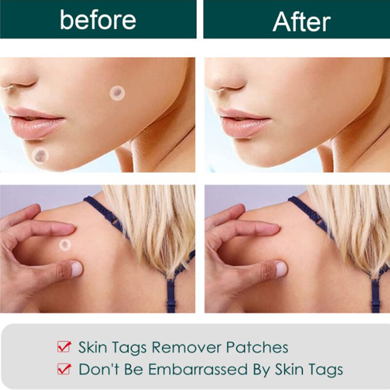 Skin Tag Remover แพทช์ Wart สติกเกอร์120Pcs ผิวทำความสะอาดผิวหมวดหมู่การรักษาเท้า Corn Plaster สิวหูดสติกเกอร์