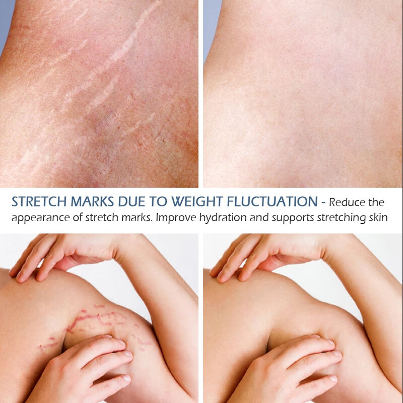 傷跡や肌の修復のためのストレッチマークマタニティクリーム,7日効果の除去,45g
