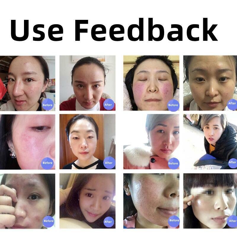 Efficie Anti arrossamento Soluation Face Serum Repair Spider Vein Essence Liquid Face Lift Firm Whitening Brighten Korean Skin Care