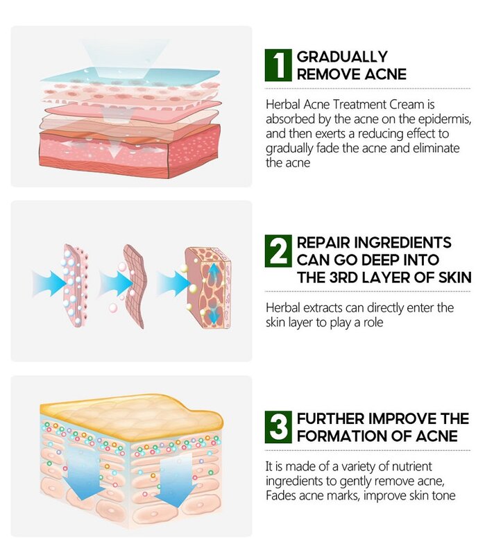 Salicylic Acid Acne Removal Spray Pimple Scar Blackhead Acne Mask Dark Spot Cure Shrink Pore Moisturizing Whitening Body Care
