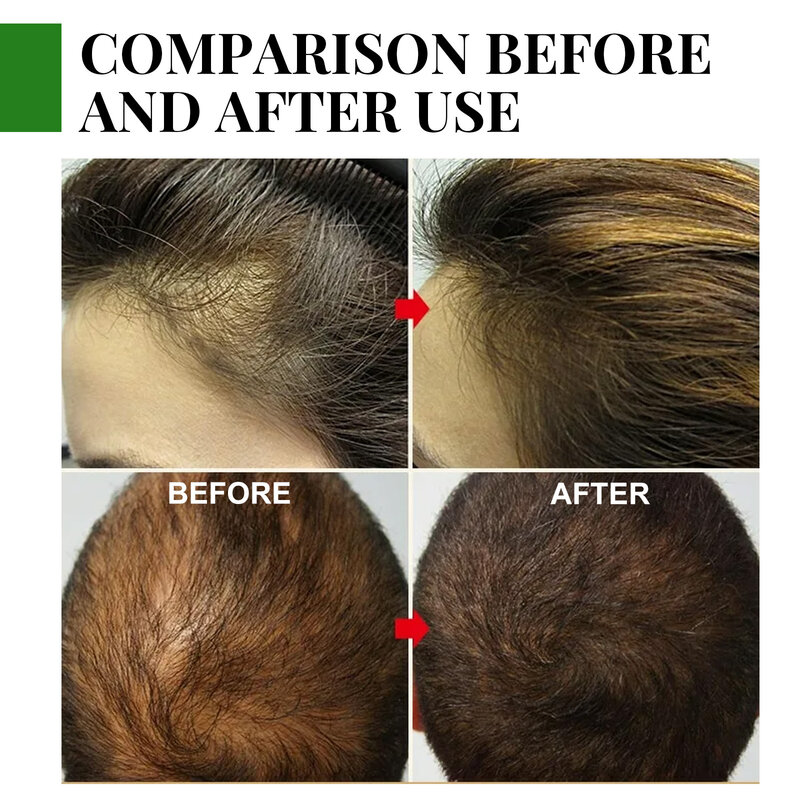 Rozmaryn pielęgnacja włosów olejki eteryczne łysienie leczenie wzrost produktu szampon Regrow krawędzie Hairline powrót Fix łysy plamy przerzedzenie