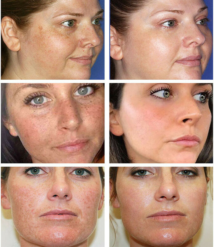 ขมิ้น Whitening Freckle Remove Skin Care ชุดสีดำสิวแผลเป็นจางหายเมลานิน Moisturizing Repair Brighten Beauty Korea Produc