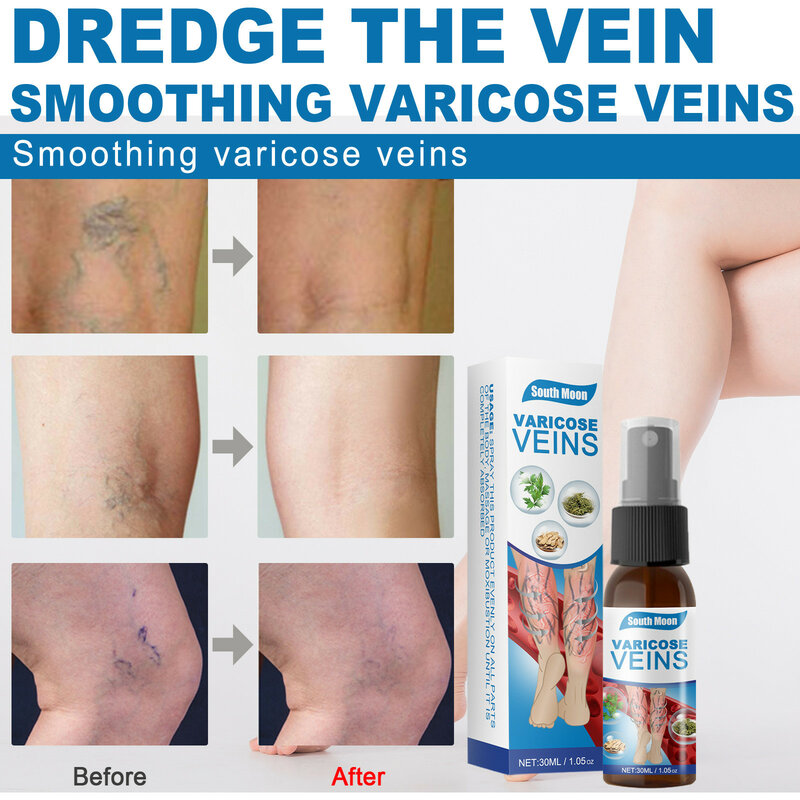 Varicose Veins RepairTreatment Spray Vasculitis Phlebitis Soothing Cream Angiitis Spider Pain Leg Relief Agent Capillary Health