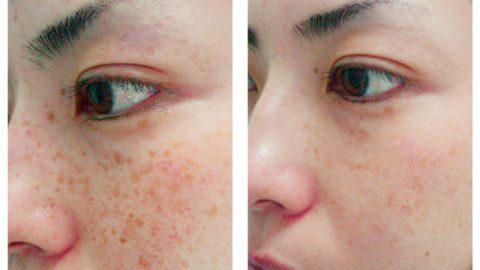Acnelyse 0.05 (2 pces) tratamento da acne rugas finas e danos faciais pápulas e pústulas força máxima com treti