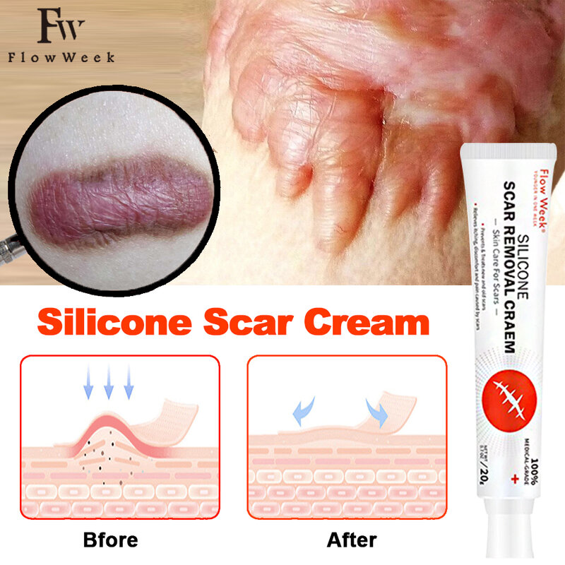Medical Scar Removal Cream, Remove Keloid Burn Surgical Scar, Stretch Mark Remover, Scar Silicone Patch, New Old Scar, Body Care
