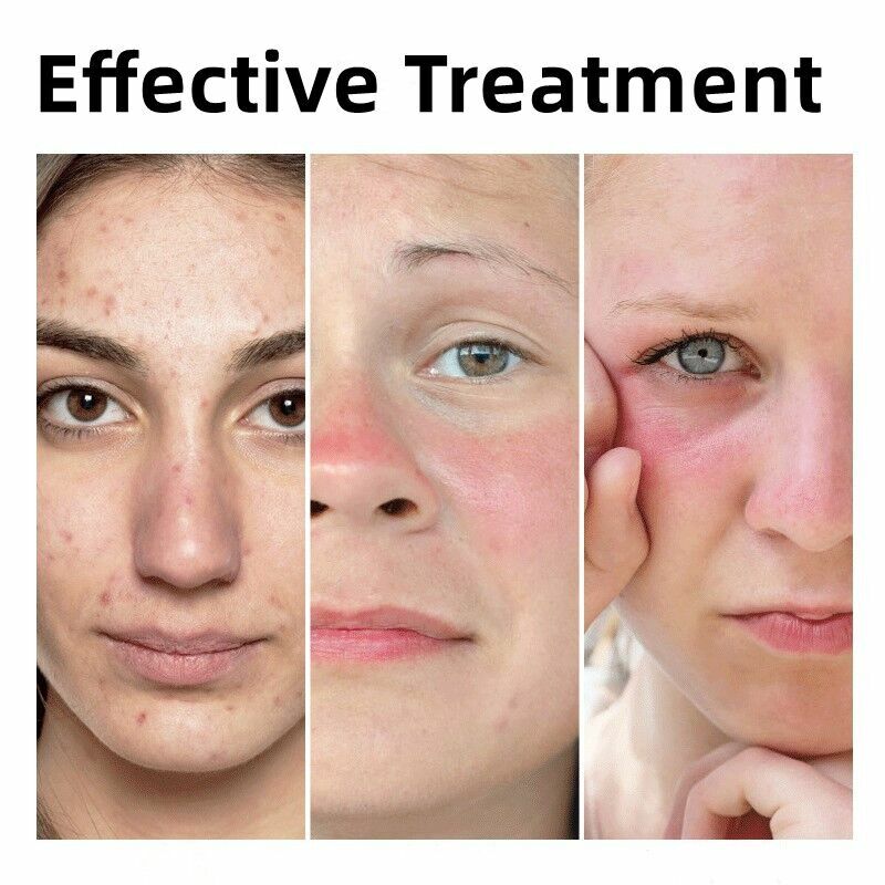 Efficie-suero facial de solución antirojeces, esencia líquida para reparación de venas araña, estiramiento facial, blanqueamiento firme, ilumina el cuidado de la piel coreano